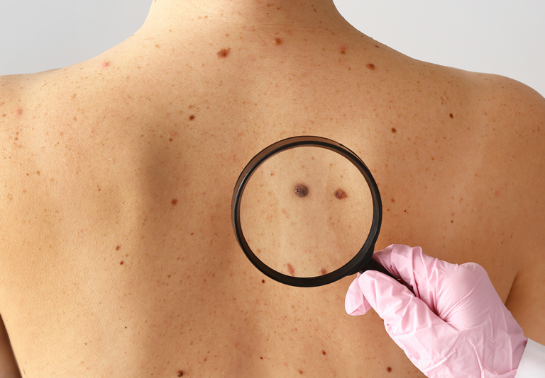 Melanoma: câncer de pele mais agressivo pode surgir de uma simples pinta e preocupa especialistas